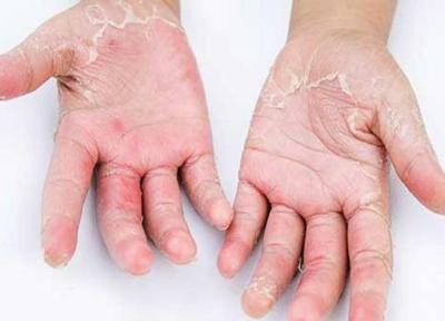 مراقب شایع ترین بیماری های پوستی در نوروز باشید